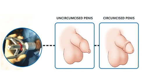 Stapler Circumcision Treatment