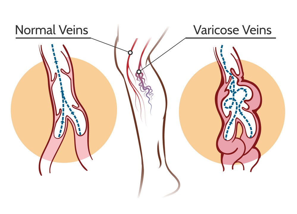 Best Laser Varicose Veins Treatment