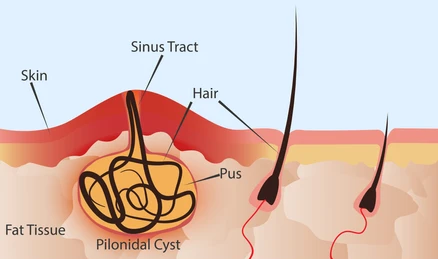 Pilonidal Sinus Laser Treatment