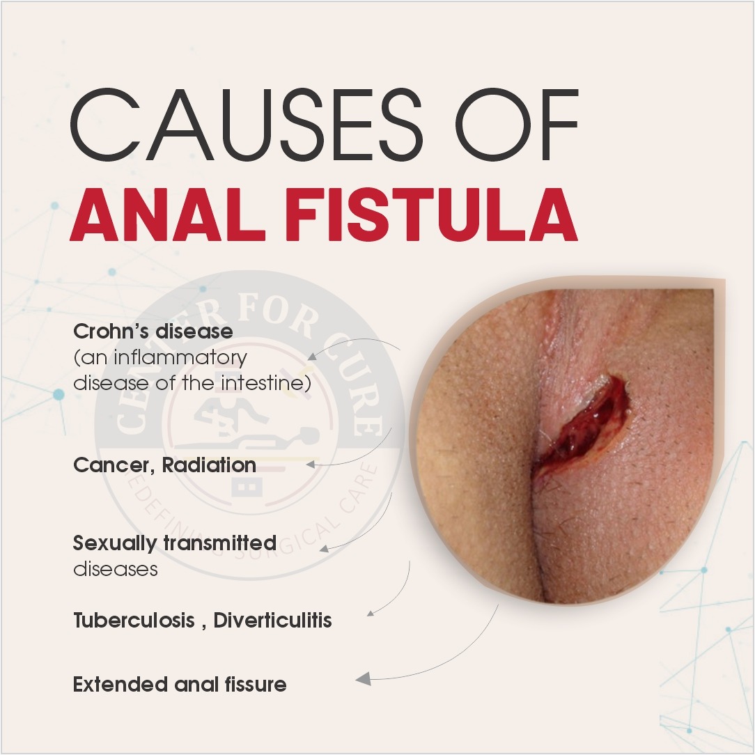 Cost of Fistula Laser Treatment