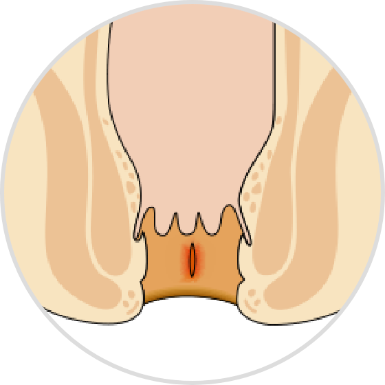 Anal Fissure Laser Treatment